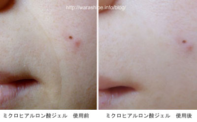 左が、ミクロヒアルロン酸ジェルをつける前の状態の肌、右が、化粧水後にミクロヒアルロン酸ジェルを塗って10~15分程度経過した肌
